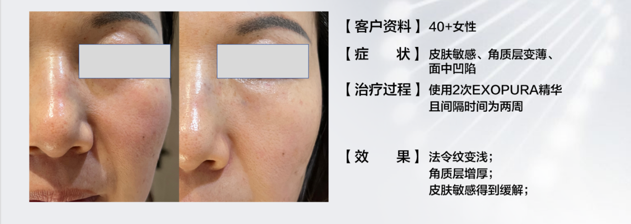 科普：细胞外囊泡：治疗皮肤老化和美白的天然疗法