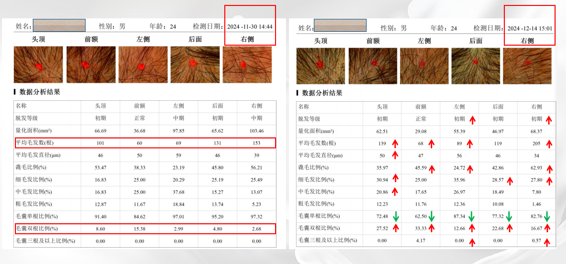 志恒生物双因子工程化外泌体治疗雄激素性脱发获验证。